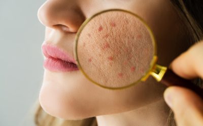 Do Chemical Peels Help With Acne?