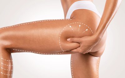 Is Liposuction Permanent? How to Maintain Your Results Long-Term
